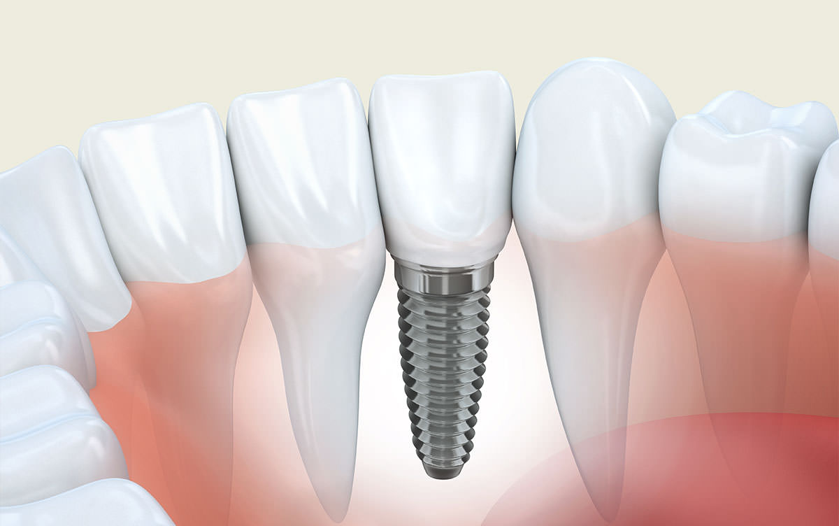 Implantologie dentaire au cabinet foulon à ribemont